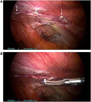 Early Surgical Intervention following Inguinal Hernia Repair with Severe Postoperative Pain
